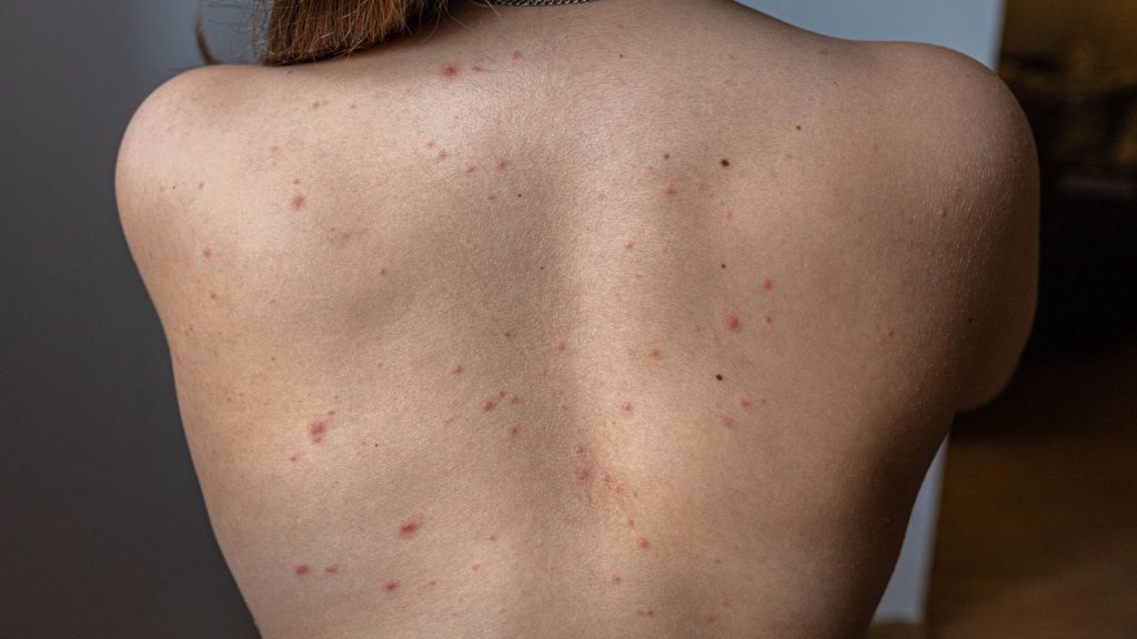 Los casos de sarna detectados en España se multiplican por 50 entre 2011 y 2023