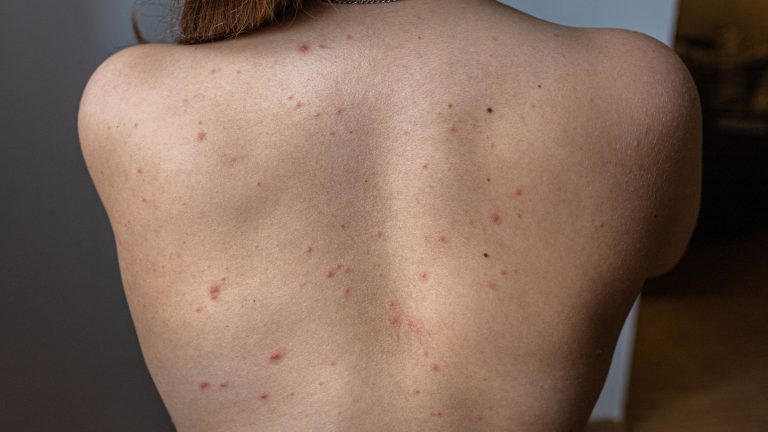 Los casos de sarna detectados en España se multiplican por 50 entre 2011 y 2023