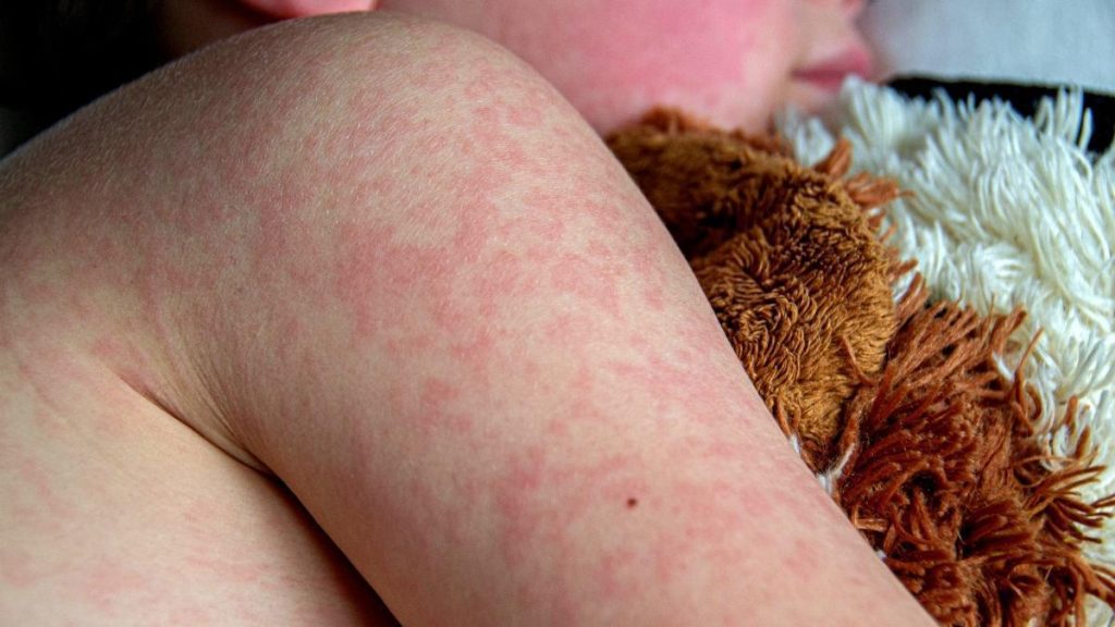 La OMS retira a España el estatus de país libre del sarampión, infección que había eliminado hace 10 años