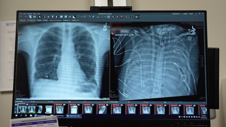 Un hombre de 33 años sobrevive dos días sin pulmones y con un fallo multiorgánico gracias a un órgano artificial