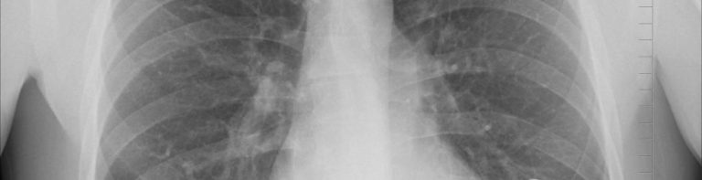 Tromboembolia pulmonar